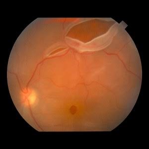 Retinal Detachment Oct