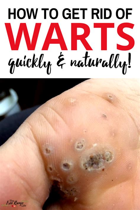 8 Best Home Remedies For Genital Warts Home Remedies