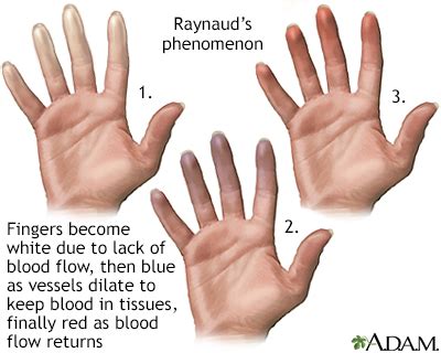 Fingers that change color Information | Mount Sinai - New York