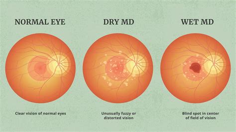 Retina – South Florida Ophthalmology