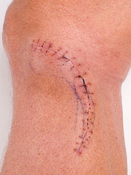 Top 60 Knee Surgery Scars Stock Photos, Pictures, and Images - iStock