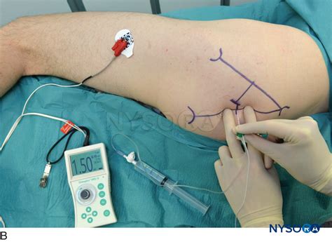 Sciatic Nerve Block - Landmarks and Nerve Stimulator Technique - NYSORA