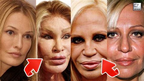 Here Is The List Of Celebs Whose Surgery Has Gone Really Bad!