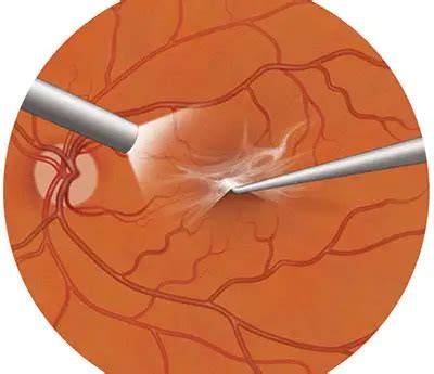 Macular Pucker Explained: Symptoms, Diagnosis, & Treatment