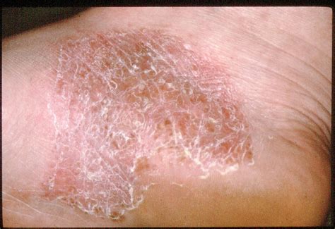 Psoriasis and psoriatic arthritis on the feet