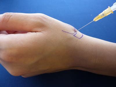 Thumb CMC joint Injection - Dorset Hand Surgery