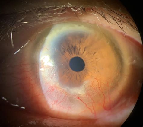 Corneal pannus : r/optometry