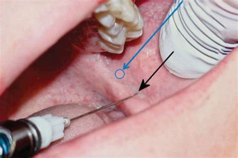 FIGURE 1. In the short needle inferior alveolar nerve block technique ...