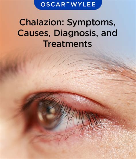 Chalazion: Symptoms, Causes, Diagnosis, and Treatments