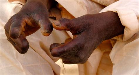 Leprosy | Africa Health Organisation