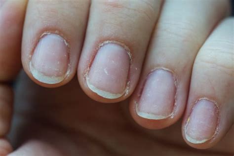 Flaking Nails: What To Do? Causes and Most Effective Remedies ...