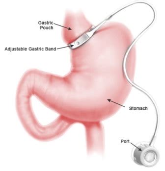 Gastric Banding or Lap Band® Surgery