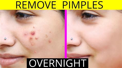 How To Lose A Pimple Overnight - Internaljapan9