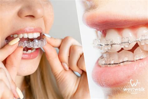 Clear Ceramic Braces vs. Invisalign: Which Is Right for You? - Westwalk