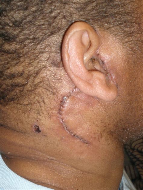 Minimally Invasive Parotid Surgery Atlanta - Advanced ENT & Allergy ...