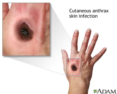 Anthrax Disease