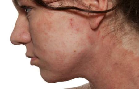 Dermatitis on face: causes, signs & symptoms | Eucerin