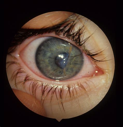 Corneal Laceration Repair