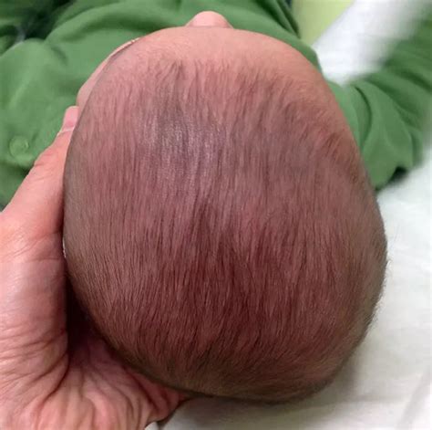 Baby Flat Head Syndrome (Plagiocephaly): Causes & Treatment