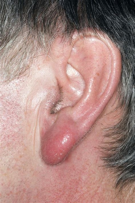 Cellulitis on the earlobe - Stock Image - C004/1219 - Science Photo Library