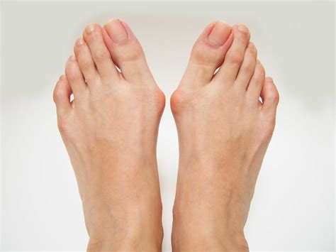 Bunions: Causes, Symptoms and Treatment | Sanders Podiatry Clinics