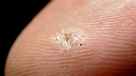 What Are Seed Warts? Causes, Prevention, and Treatment – NaturalEsCool.com