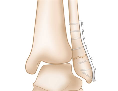 Medial Malleolus