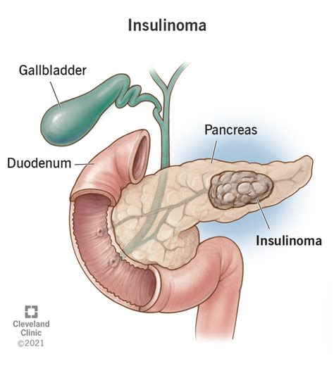 Pancreas Diabetes Diagram