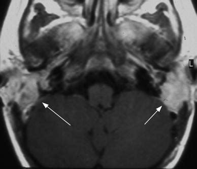 of the Jugular Foramen | Radiology Key