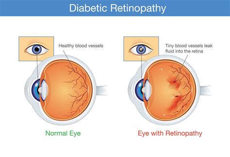 A vitamin A analog may help treat diabetic retinopathy | Diabetic ...