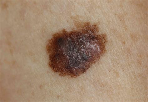 First Signs Of Skin Cancer