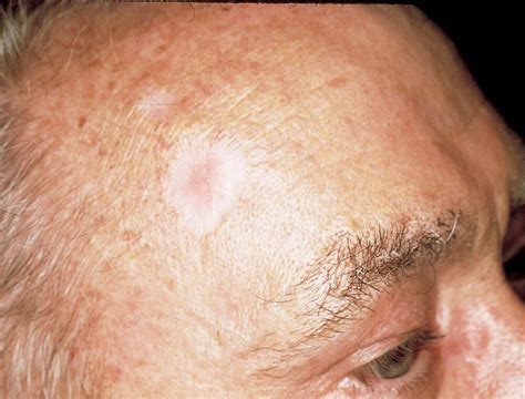 Skin Cancer on Face: Types, Pictures, Treatment, and Prevention