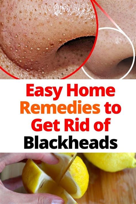 Easy Home Remedies to Get Rid of Blackheads - How To Be Fit in 2020 ...