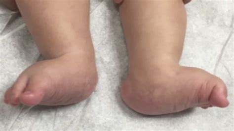 Congenital vertical talus causes, symptoms, diagnosis, treatment ...