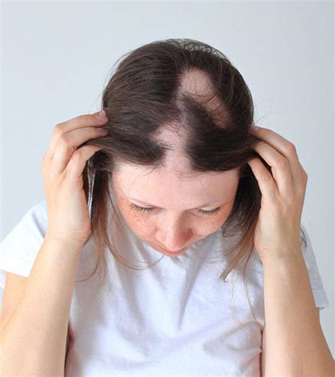 Patchy Hair Loss Alopecia Areata - Infoupdate.org