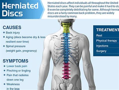 Infographics - South County Spine Care Center