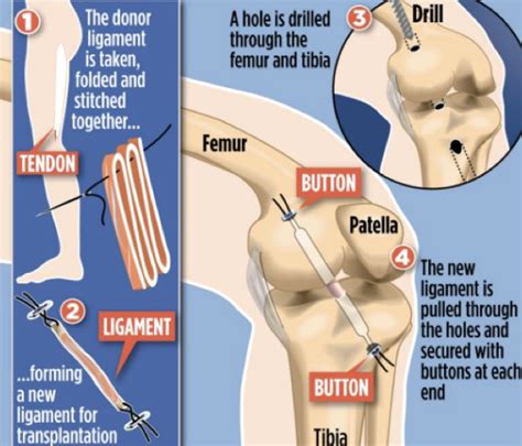 ACL Reconstruction Post Operative Information | Glenferrie Sports and ...