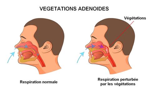 Végétations : Définition, Symptômes, Opération, ça Repousse ? - Unsujet