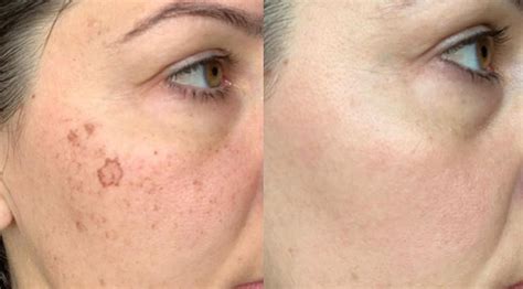 Laser Pigmentation Removal Canterbury & Kent | The Grove Clinic