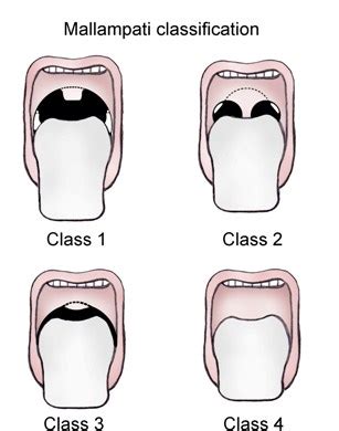 OSA Surgery and Mallampati Score | Dr Paulose