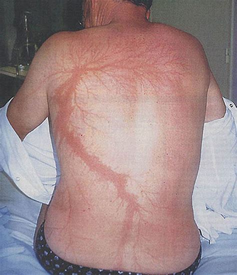 Lichtenberg Scars — Nature’s Tattoo You Don’t Want To Have | Bored Panda