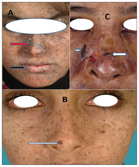 Xeroderma pigmentosum at a tertiary care center in Saudi Arabia ...