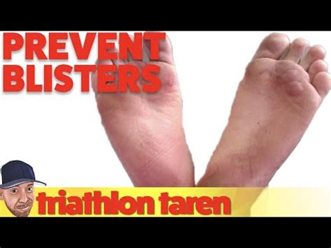 How Runners Can Prevent and Treat Feet Blisters - Fitness Tips | 2023