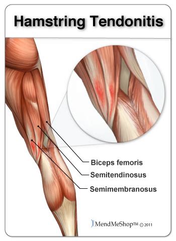 Biceps Femoris Tendon Pain