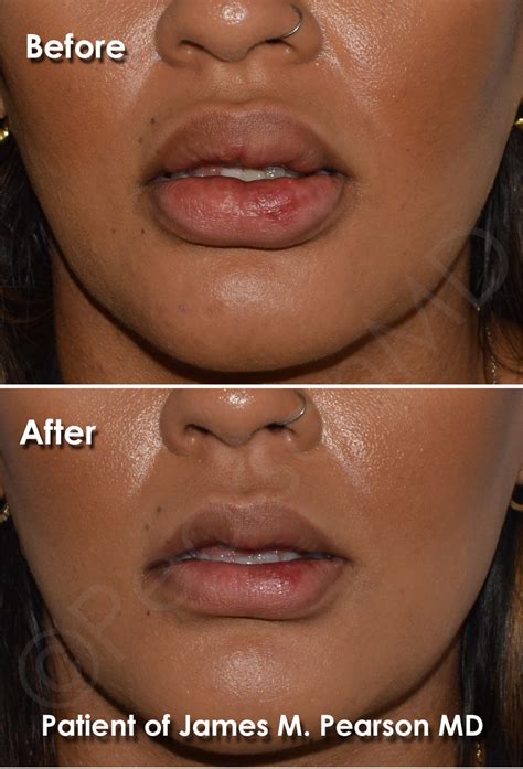 Lip Reduction Photos - Before & After - Dr. James Pearson Facial ...