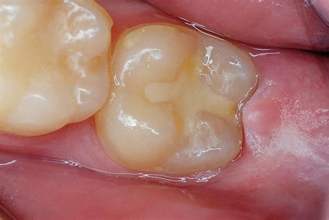 Glass Ionomers Filling: Advantages and Disadvantages in Dentistry