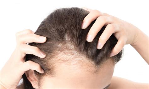 Dealing with Hair Loss in Women: A Comprehensive Guide - Nhlink.net