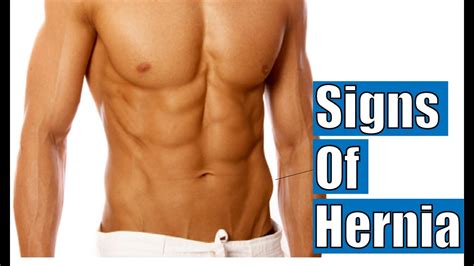 Signs of Hernia | Inguinal hernia symptoms - YouTube