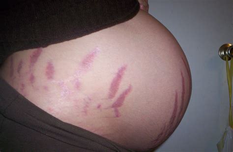 Pregnancy Stretch Marks Photo Gallery