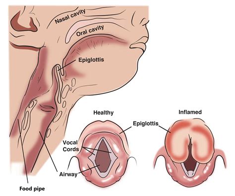 Epiglottitis - ENT Info